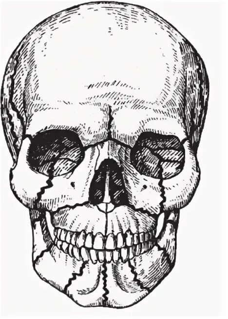 Деформация кости черепа. Переломы костей лицевого и мозгового черепа. Лицевая кость черепа перелом. Переломы лицевого черепа по Лефору. Перелом лицевой кости черепа.