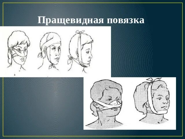 Техника наложения пращевидной повязки