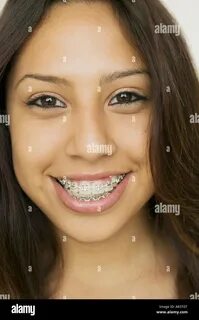 heart_plus. girl wearing braces. www.alamy.comimage-license-details?v=1ht...