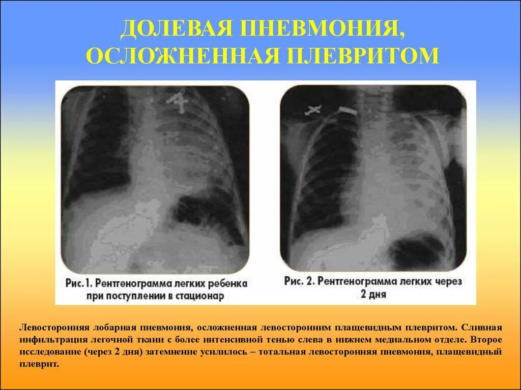 Пневмония легких осложнения. Односторонняя пневмония.