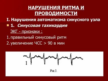 Нарушение проводимости по нижней стенке