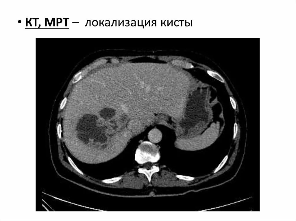 Эхинококкоз брюшной полости кт. Эхинококковая киста печени кт. Кт киста печени эхинококковая киста. Образования печени кт