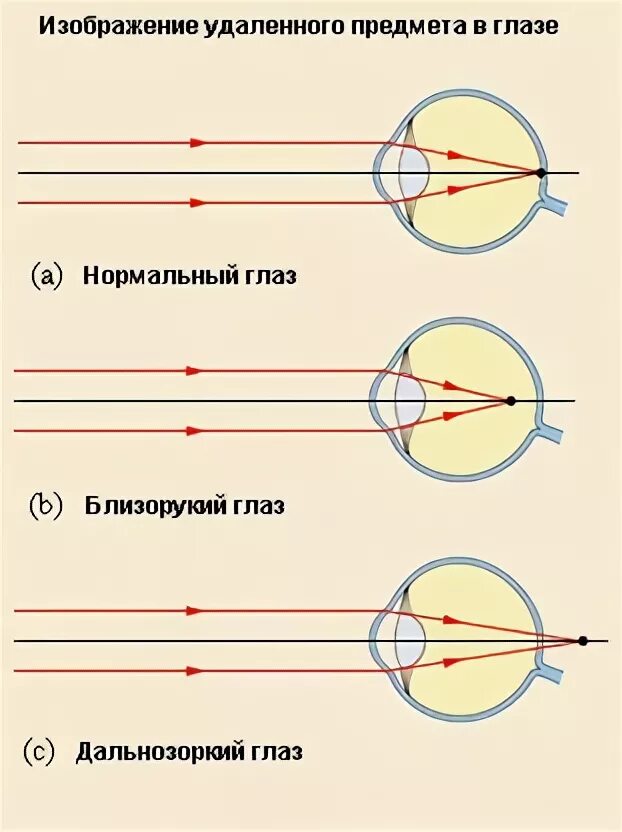 Ход лучей глаза человека. Схема хода параллельного пучка лучей дальнозоркого глаза. Ход лучей в близоруком и дальнозорком глазу. Ход параллельного пучка лучей близорукого глаза. Нормальный глаз дальнозоркий и близорукий схема.