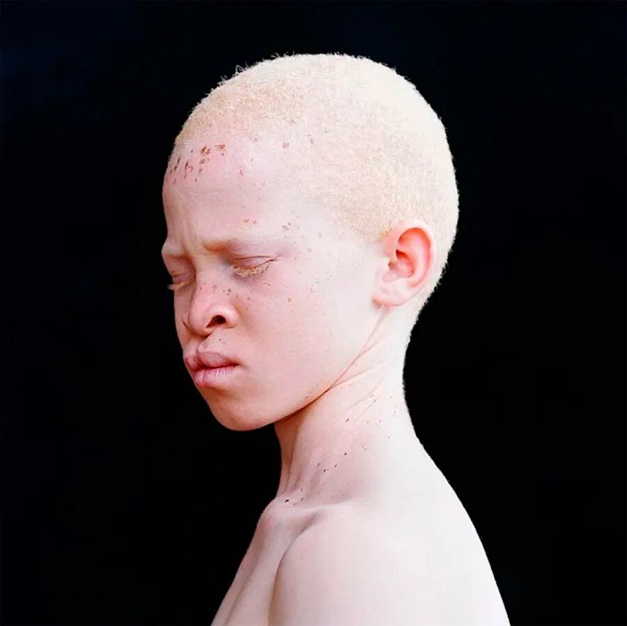 Как люди рождаются альбиносами. Тотальный альбинизм. Наследственная болезнь альбинизм. Генные болезни альбинизм.