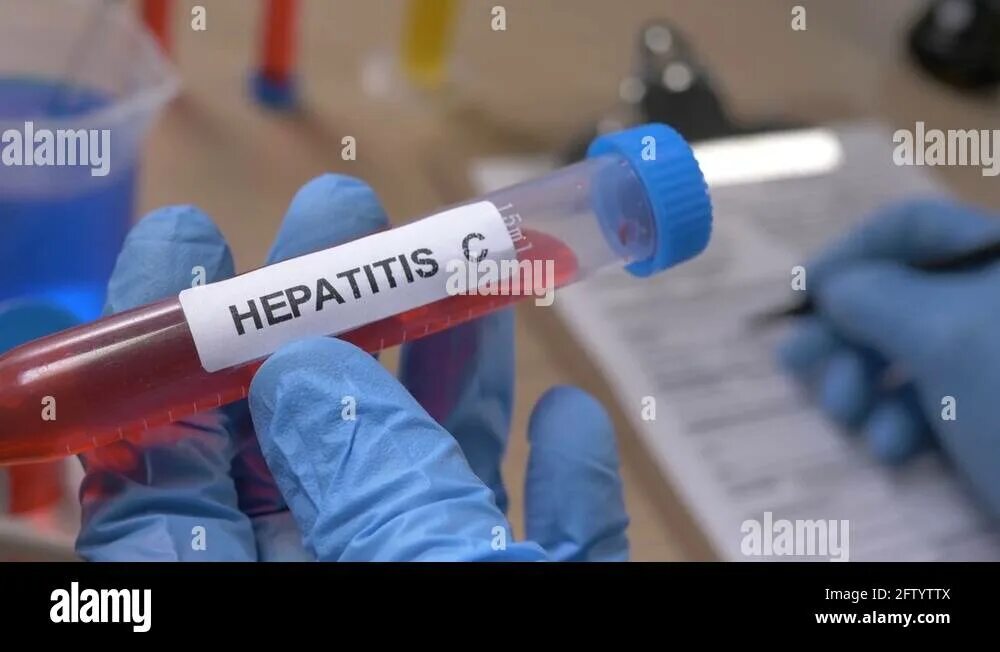 Пробирка с вирусом. Гепатит b и c. Пробирки на гепатит. Пробирки на гепатит. Пробирки на гепатит.