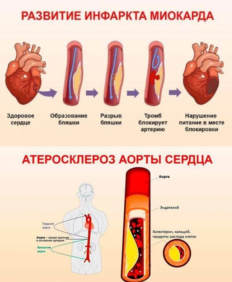 Как очистить сосуды от холестериновых тромбов. Чистка артерий и сосудов. Разжижение холестериновых бляшек. Продукты для чистки кровеносных сосудов.