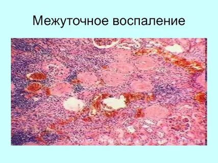 Воспаление вещество