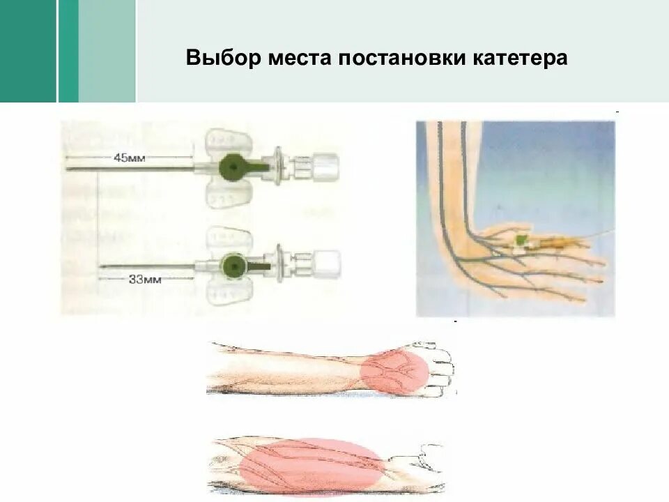 Катетеризация вены алгоритм. Катетеризация периферических вен алгоритм. Постановка периферического катетера в Вену. Постановка внутривенного катетера алгоритм.