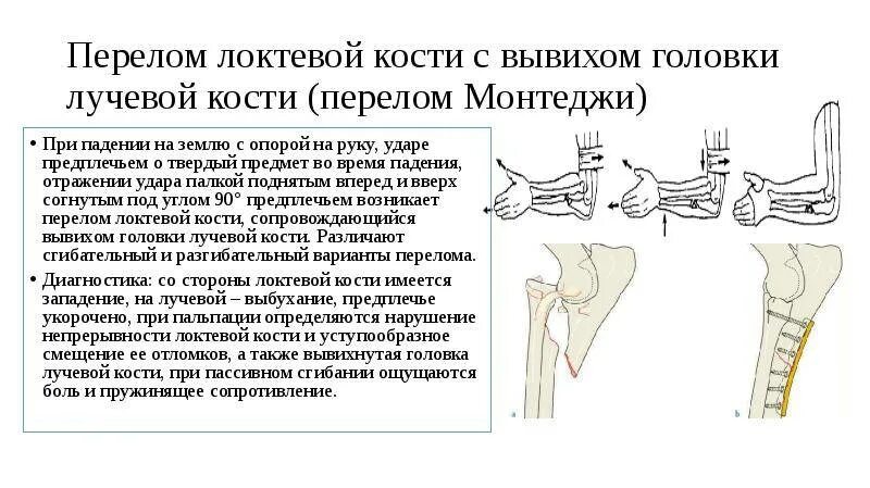 Перелом лучевой кости с вывихом головки локтевой кости. Перелом вывих головки лучевой кости. Перелом головки локтевой кости. Перелом локтевой вывих лучевой.