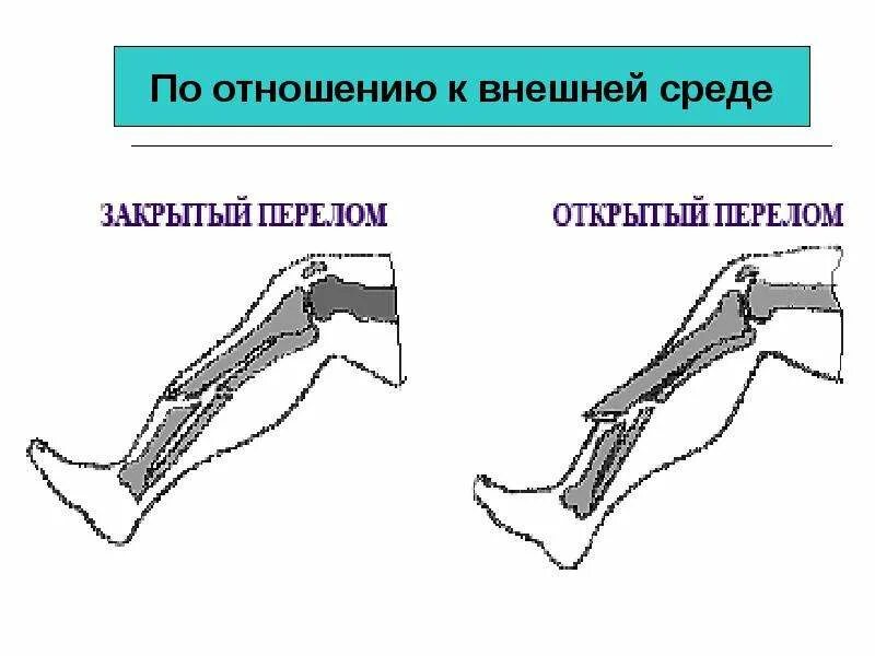 Закрытый перелом это. Закрытый перелом это