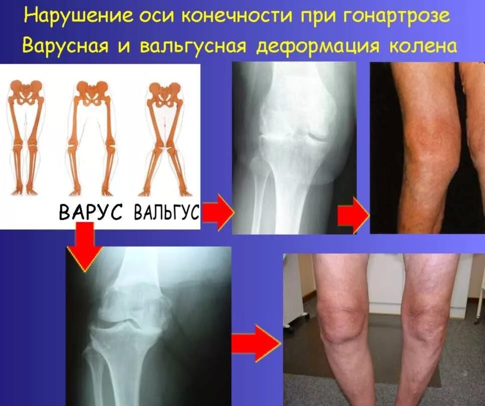 Деформирующий артроз коленных. Варусная деформация коленных суставов артроз. деформирующий гонартроз. деформирующий остеоартроз коленного сустава. остеоартроза нижних конечностей.