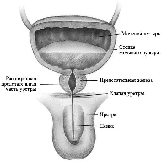 Строение мочевого пузыря мочеиспускательного канала. Клапан задней уретры рентген. Врожденные клапаны уретры. Врождённый клапан задней уретры. Клапан задней уретры типы.