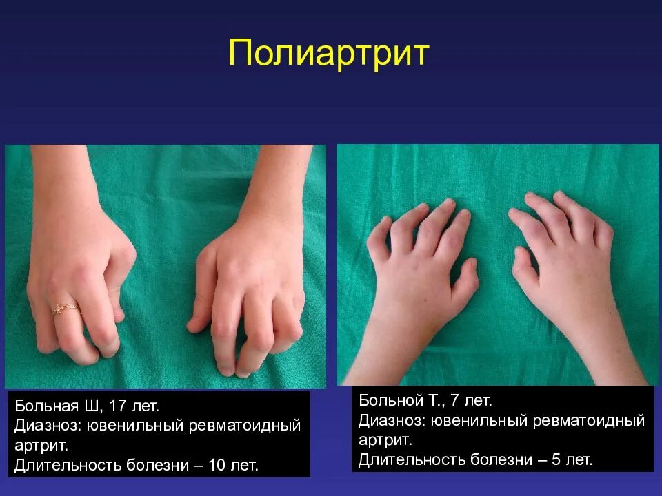 Ревматоидного артрита у детей клинические. Юнивиальный ревматоидный артрит. Ювенильный артрит и ревматизм. Ювенильный ревматический артрит классификация. Ювенинильный ревматоидный артрит.