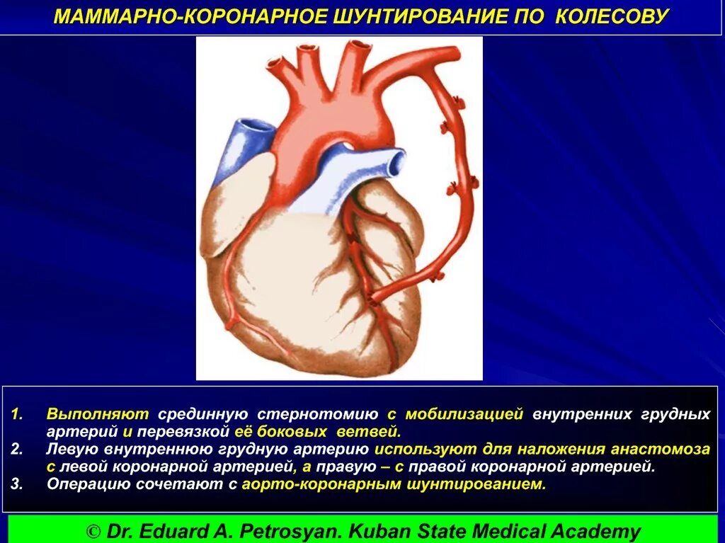 Операция коронарных сосудов. Операция Колесова маммарно коронарное шунтирование. Аортокоронарное шунтирование техника. Маммарокоронарное шунтирование техника. Аортокоронарное шунтирование ЭФЛЕР.