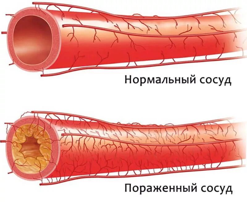 Атеросклероз коронарных артерий симптомы. Атеросклероз венечных артерий сердца. Атеросклероз сосудов брахиоцефальных артерий. Нормальный сосуд и Атеросклерозный сосуд. Заболевания артерий вен