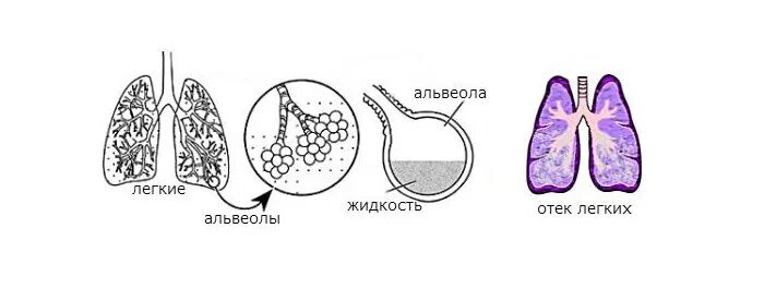 У кита альвеолярные легкие. Кардиогенный отек легких патогенез. Схема развития отека легких. Некардиогенный отек легкого патогенез. Механизм развития альвеолярного отека лёгких.