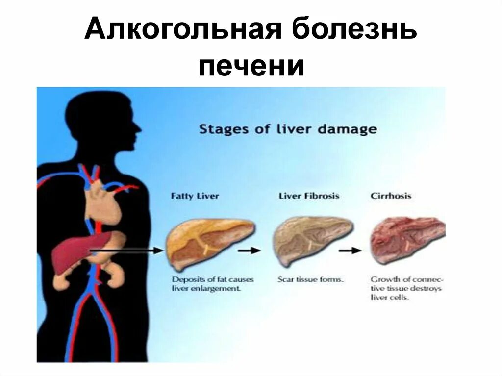 Классификация клинических форм алкогольной болезни печени. Алкогольная болезнь печени. Профилактика алкогольной болезни печени. Хроническая форма алкогольного поражения печени.