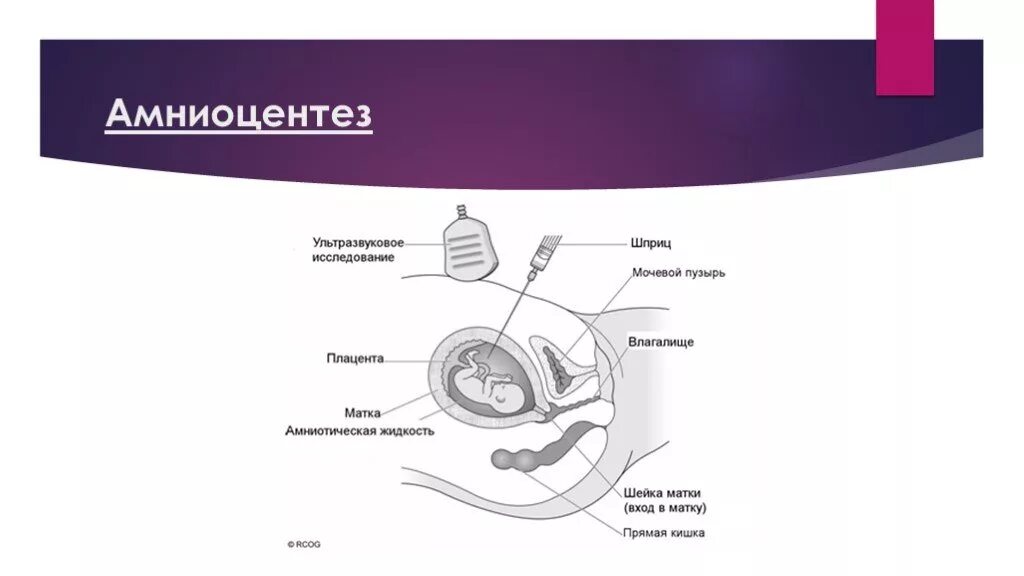 Инвазивный тест при беременности. Пренатальная диагностика амниоцентез. Инвазивные методы диагностики. Инвазивные методы пренатальной диагностики.