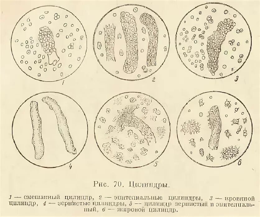 Повышены цилиндры в моче. Лейкоциты в моче микроскопия. Гиалиновые цилиндры микроскопия. ФСВОК микроскопические исследования осадка мочи цикл 2-22. Микроскопия мочи почечный эпителий.