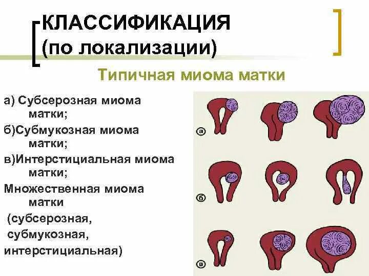 Матка в каком месте. Миома матки классификация по локализации. Классификация миомы по размерам узла. Миома матки классификация по размерам. Классификация миом по локализации.