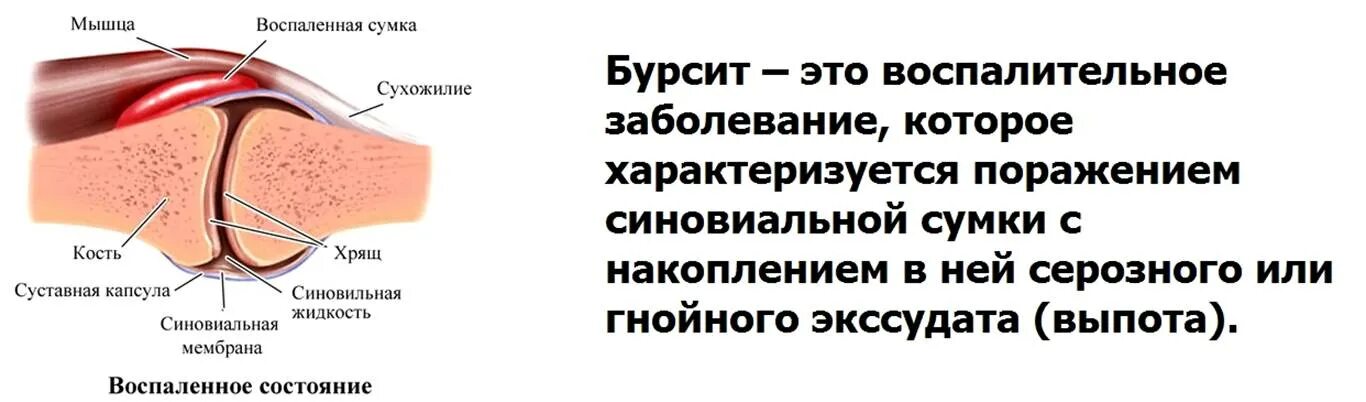 Воспаление синовиальной сумки. Воспаление синовиальной сумки локтевого сустава. Воспаление Бурсы локтя. Бурса синовиальная сумка воспаление. Эффективное лечение бурсита локтевого