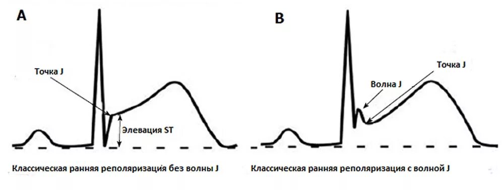 Ранняя реполяризация желудочков сердца на ЭКГ. Ранняя реполяризация желудочков на ЭКГ. Синдром ранней реполяризации на ЭКГ. Синдром СРРЖ на ЭКГ. Нарушение признаков реполяризации