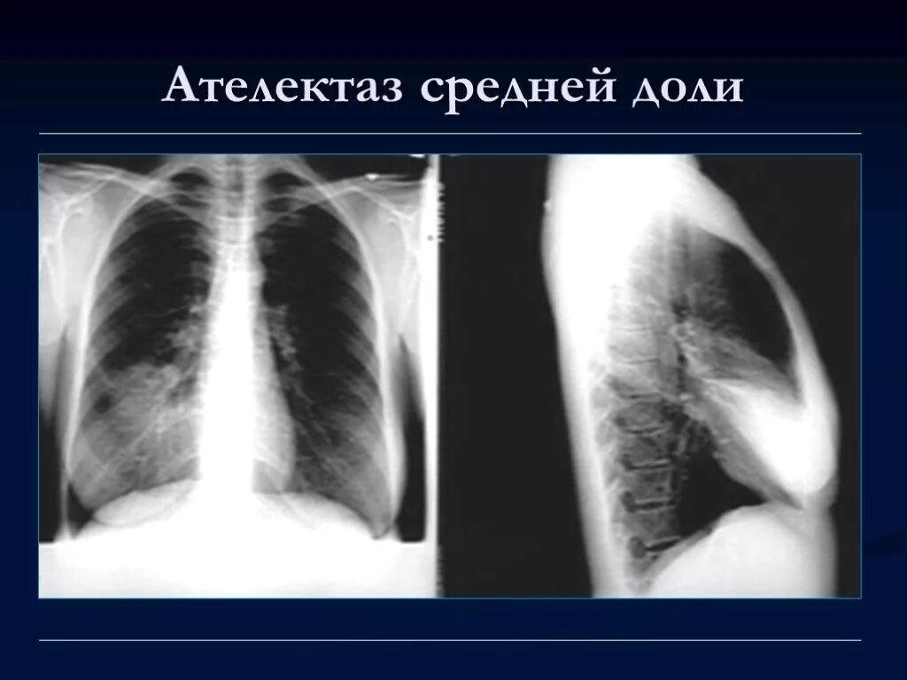 Спадение бронха