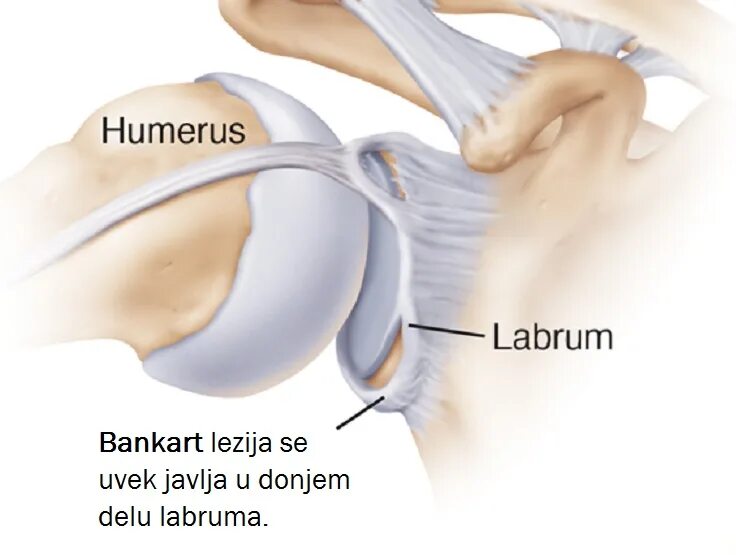 Повреждение губы плечевого сустава. Повреждение Банкарта плечевого сустава. Повреждение Банкарта операция и Хилл-Сакса плечевого сустава. Банкарт плечевой сустав. Повреждение Хилл-Сакса плечевого сустава мрт.