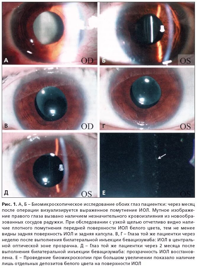 Что нельзя после операции катаракты глаза. Катаракта биомикроскопия. Биомикроскопия хрусталика норма. Помутнения хрусталика биомикроскопия.