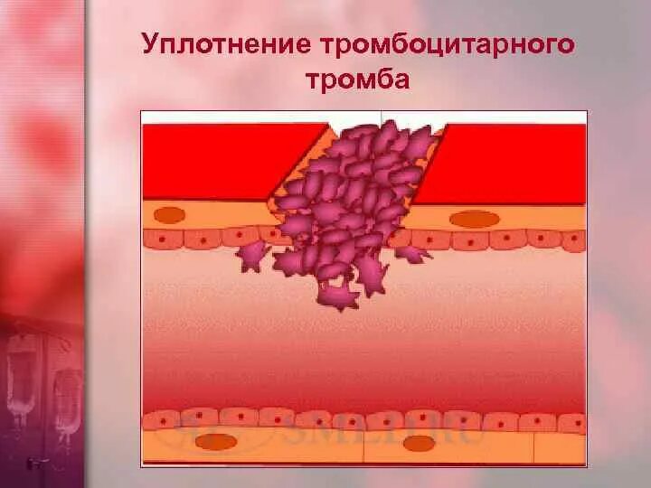 Уплотнение тромбоцитарного тромба. Ретракция тромбоцитарного тромба. Образование тромба гемостаз. Схема образования тромба. Уплотнение тромба