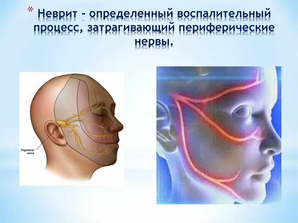 Неврит нижнечелюстного нерва. Неврит тройничного нерва. Воспаление лицевого нерва. Неврит и невралгия тройничного нерва.