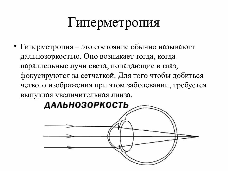 Гиперметропия биомикроскопия. Гиперметропия это в анатомии. Заболевание глаз гиперметропия. Клинические проявления гиперметропии. Лучи света фокусируются за сетчаткой