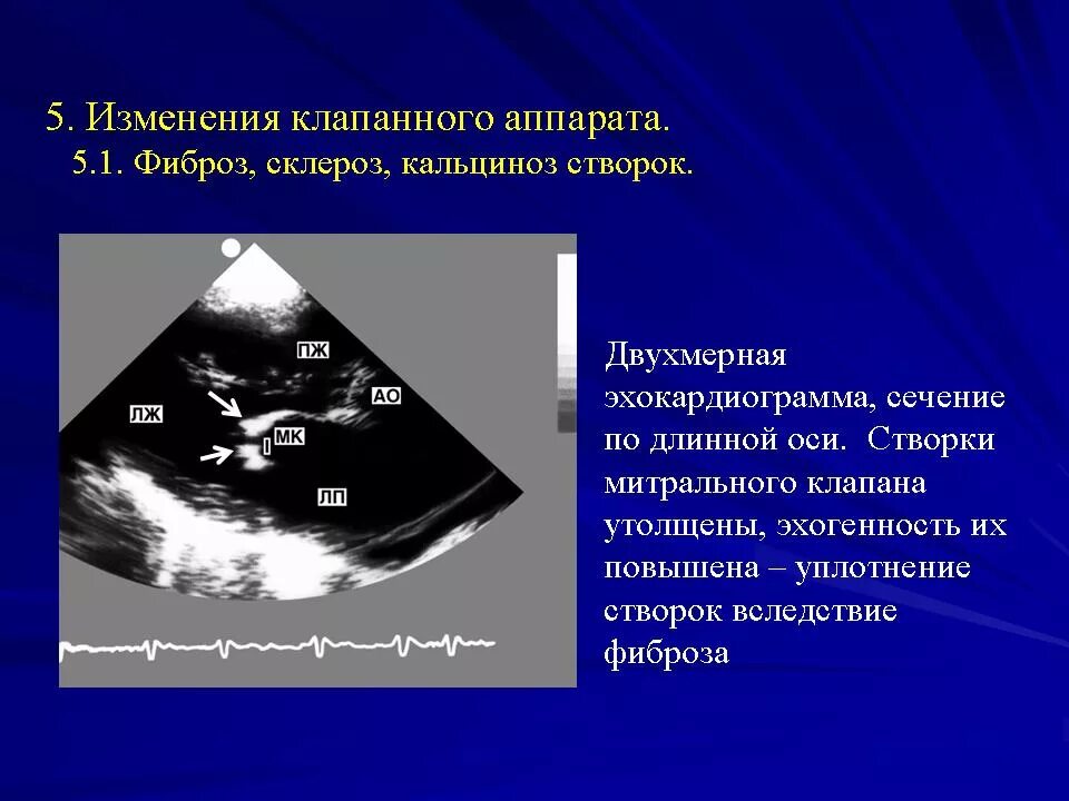 Створки митрального клапана на ЭХОКГ. Створки аортального клапана на ЭХОКГ. Фиброз створок митрального клапана на ЭХОКГ. Створки аортального клапана на УЗИ.