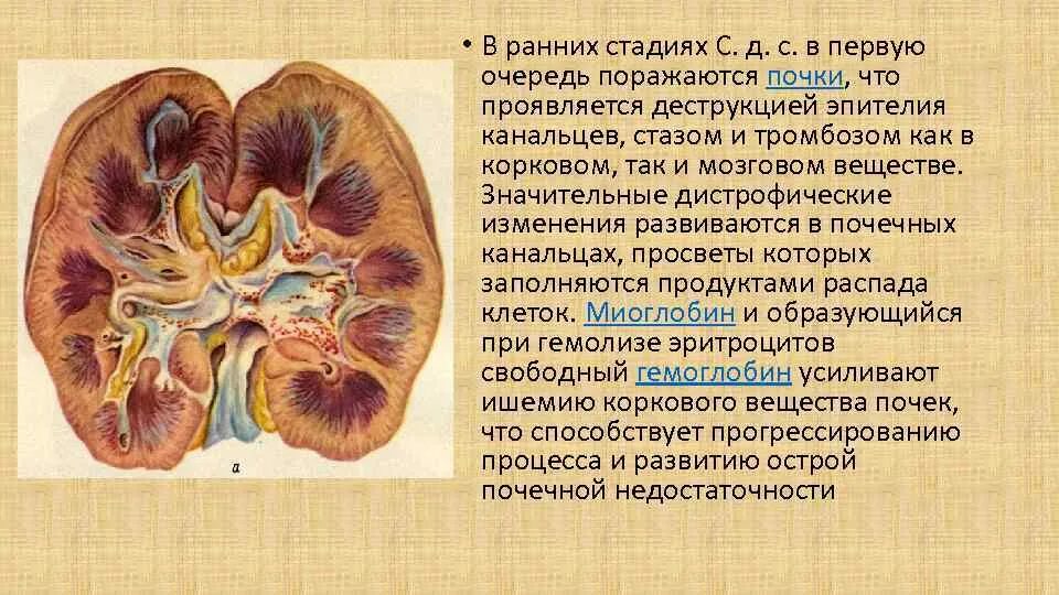 Почках и в головном мозге. Корковое и мозговое вещество почки. Почки при краш синдроме. Строение коркового и мозгового вещества почки.