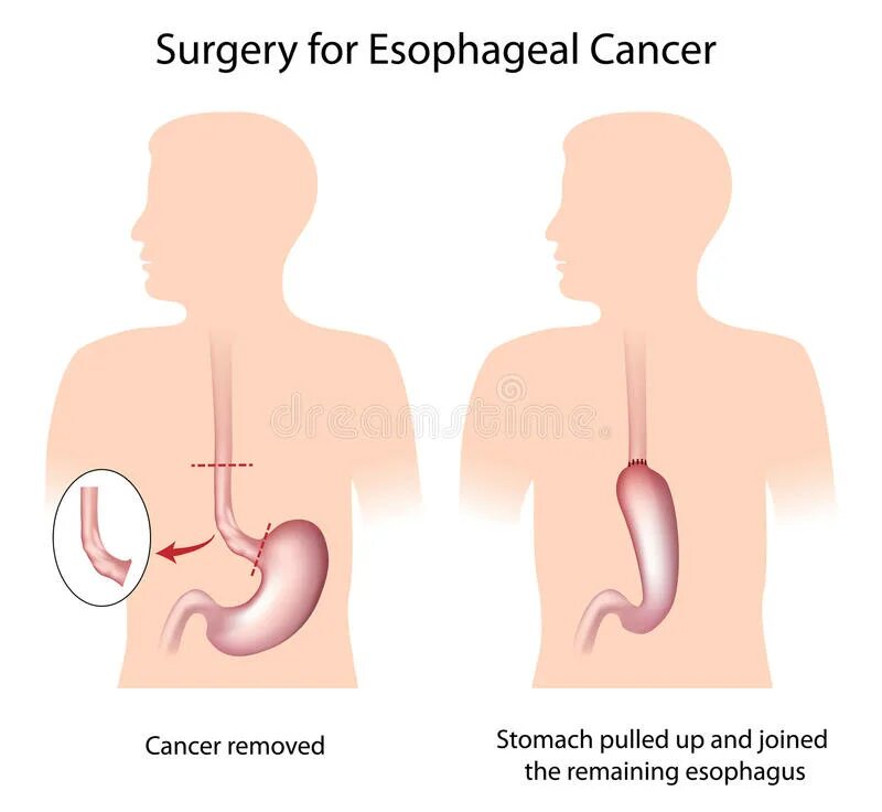 Операции на пищеводе. Разрез пищевода при операции. Операция Льюиса пищевод. Резекция пищевода операции.