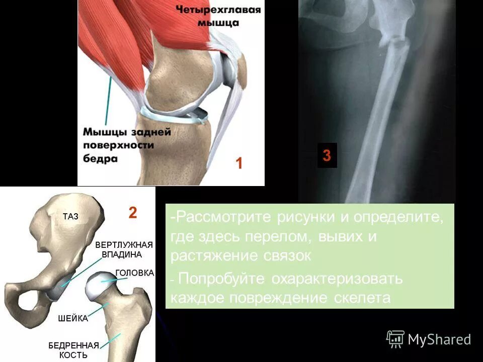 Бедренный разрыв. Перерастяжение связок тазобедренного сустава симптомы. Разрыв сухожилия тазобедренного сустава. Растяжение бедренной кости.