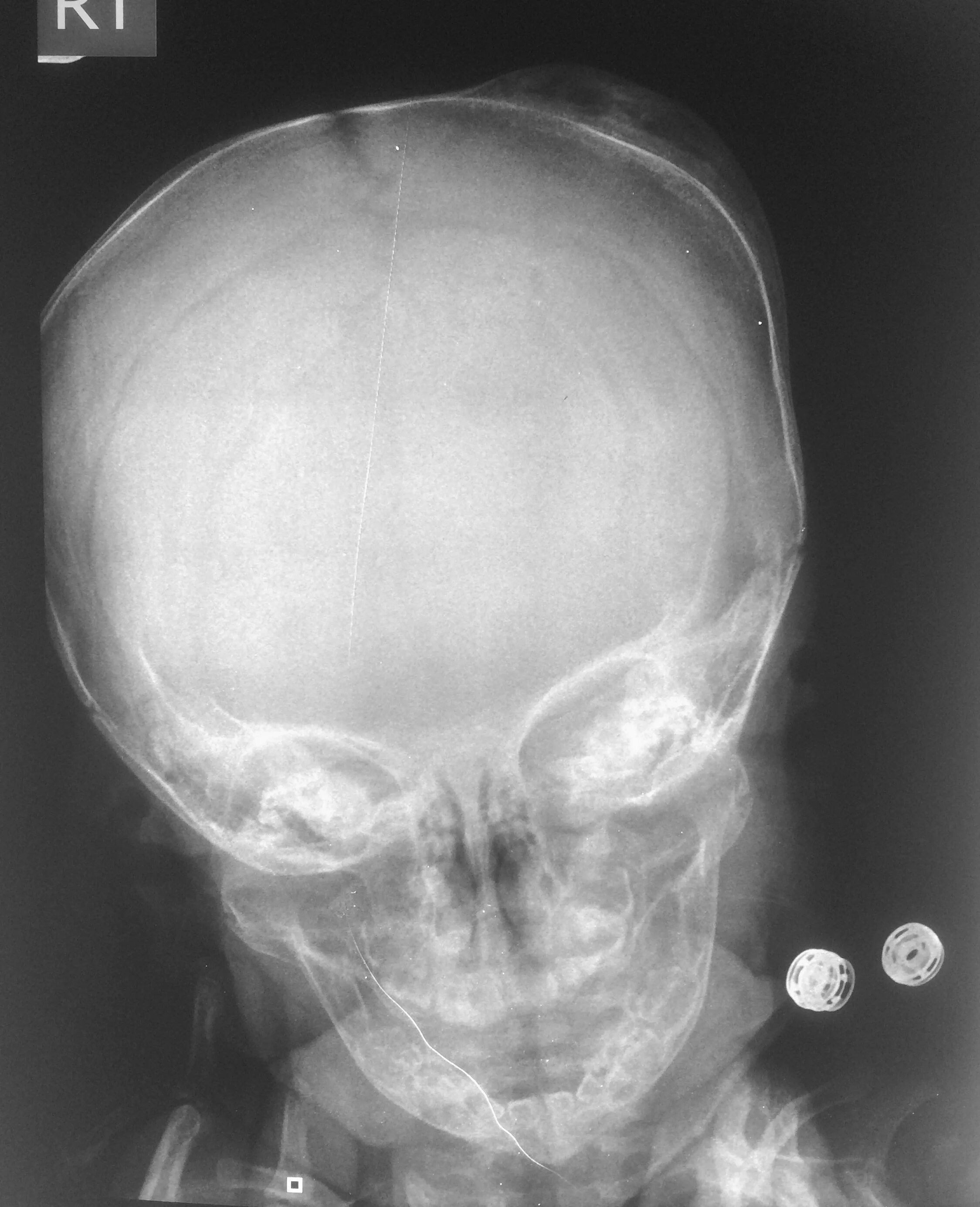 Кости черепа рентген. Остеома затылочной кости рентген. Остеома костей черепа рентген. Перелом теменной кости черепа рентген. Остеома лобной рентген.