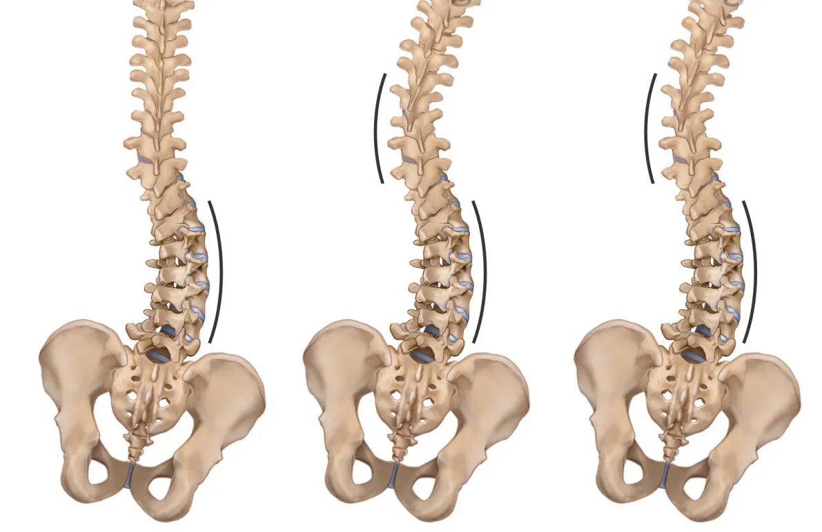 Сколиоз позвоночника s образный. Сколиоз позвоночника s образный грудного. Сколиоз с ротацией позвонков. S образный сколиоз поясничного отдела.