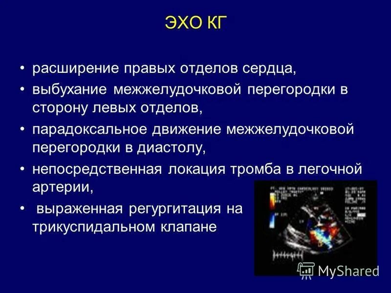 парадоксальное движение мжп. парадоксальное движение. заболевания миокарда лучевая диагностика. аневризма межжелудочковой перегородки эхо. парадоксальный характер движения межжелудочковой перегородки.