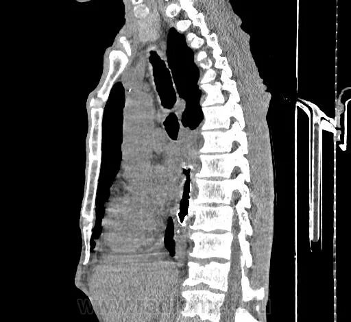 Инородное тело пищевода компьютерная томограмма. Кт пищевода и желудка
