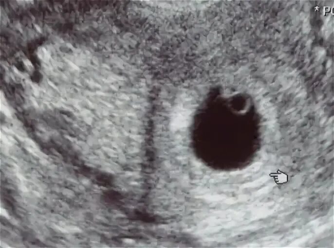 Желточный мешок 2 мм. Плодное яйцо 3мм и желточный мешок 3мм. узи 5 недель плодное яйцо 7 мм.