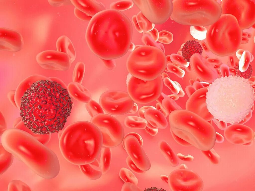 Хронические заболевания крови. Лейкоз клетки крови. Острый лейкоз кровяные клетки. Злокачественные заболевания крови.