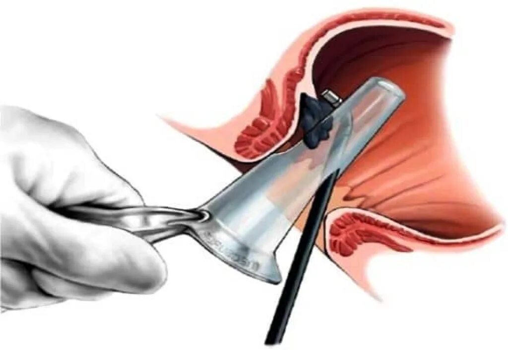 Кровь при трещине заднего. Инфракрасная коагуляция геморроя. Фотокоагуляция геморроя. Инфракрасная электрокоагуляция геморроидальных узлов. Инфракрасная фотокоагуляция.