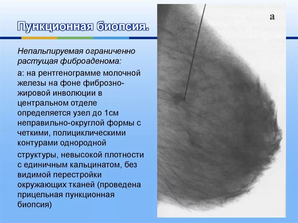 Фиброаденома молочной железы 1б. Фиброаденома молочной железы маммография заключение. Фиброзно железистая структура молочной железы. Фиброаденома молочной на маммографии. Фиброаденоматоз bi