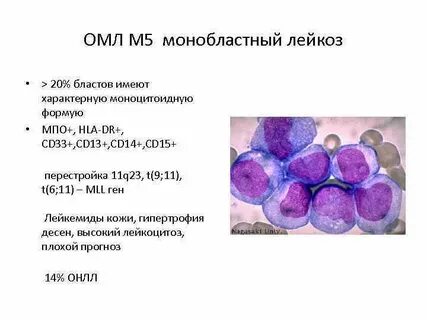 Острый монобластный лейкоз