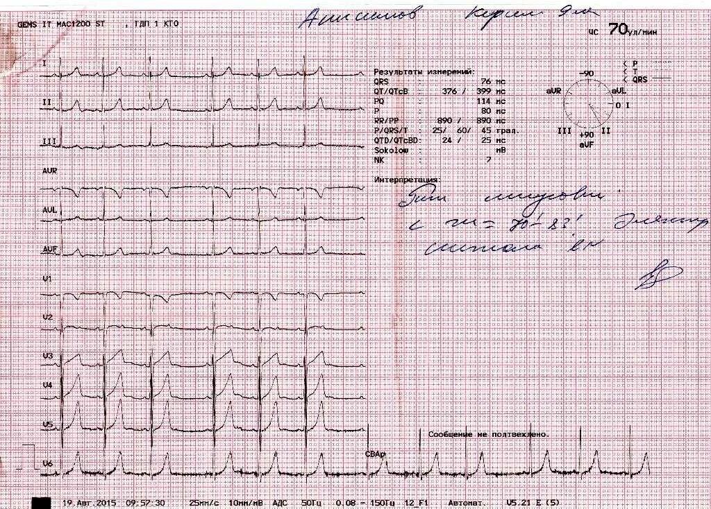 ЭКГ расшифровка кардиограммы показатели. Результат ЭКГ расшифровка норма. Расшифровка результатов ЭКГ показатели нормы. Кардиограмма сердца расшифровка норма. Заключения экг примеры