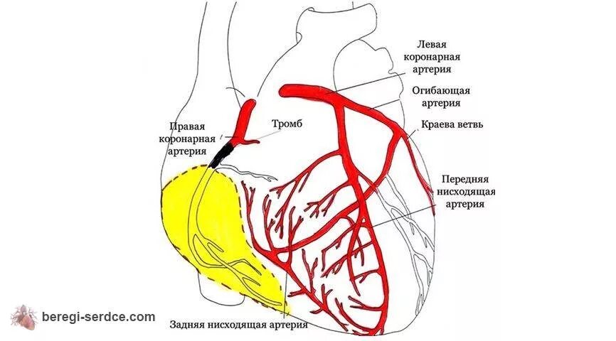 Инфаркт миокарда окклюзия артерий. Кровоснабжение миокарда схема. Задне нижняя стенка левого желудочка кровоснабжение. Коронарные артерии анатомия схема.