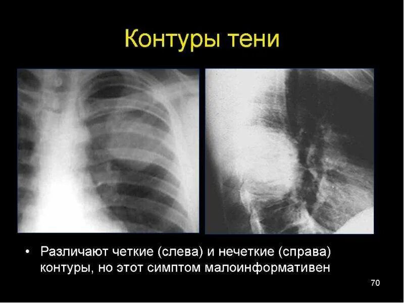 Затемнение средней интенсивности с нечеткими контурами. Нечеткие контуры в легких. Нечеткие контуры легкого. Билатеральное поражение легких. Рентген легких затемнение легкого.