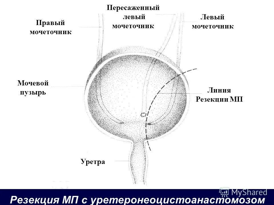 Размер мочевого пузыря у мужчин. Мочеточник мочевой пузырь уретра. Схема строения мочевого пузыря. Клапан шейки мочевого пузыря. Опухоли мочеточника и мочевого пузыря.