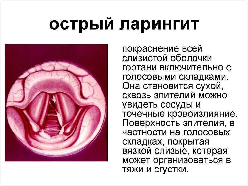Что такое фарингит симптомы лечение у взрослых